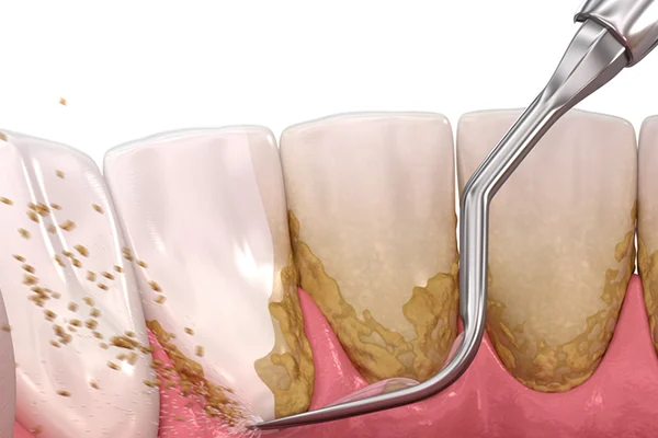 Diş Taşı Temizliği