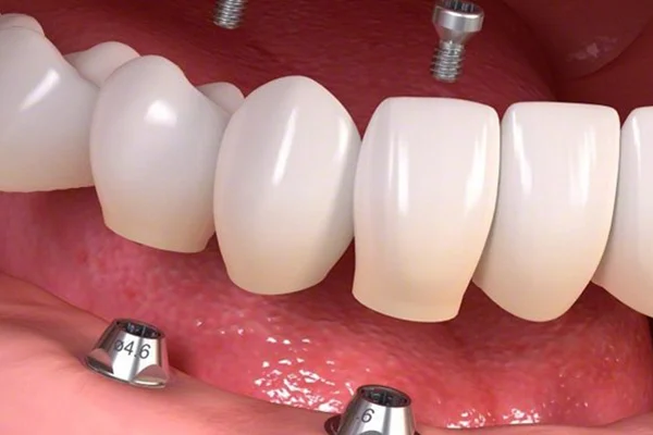 İmplant Üstü Protez