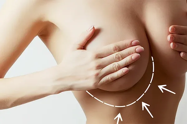 Breast Augmentation