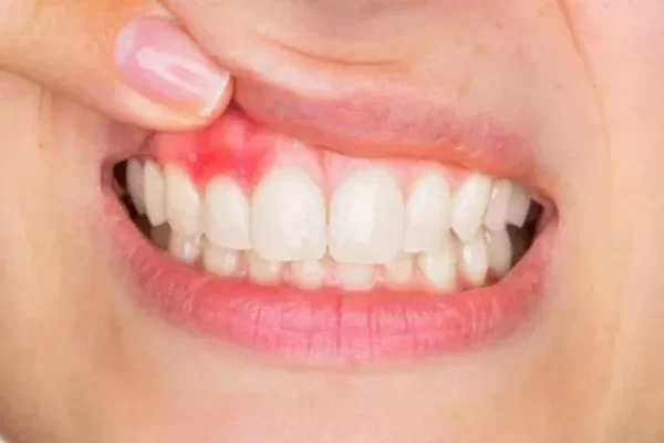 Diş Eti Estetiği (Pembe Estetik)