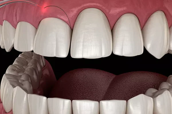 Diş Eti Şekillendirme