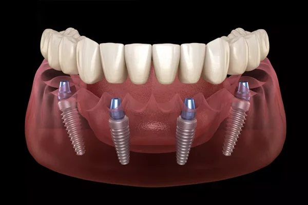 All-on-4 İmplant