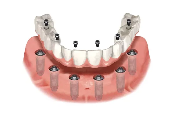 All‑on‑6 İmplant