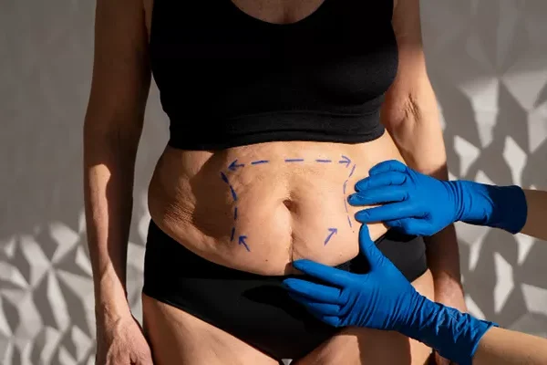 High Definition Liposuction