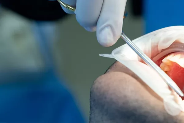 Dikişli Diş Çekimi